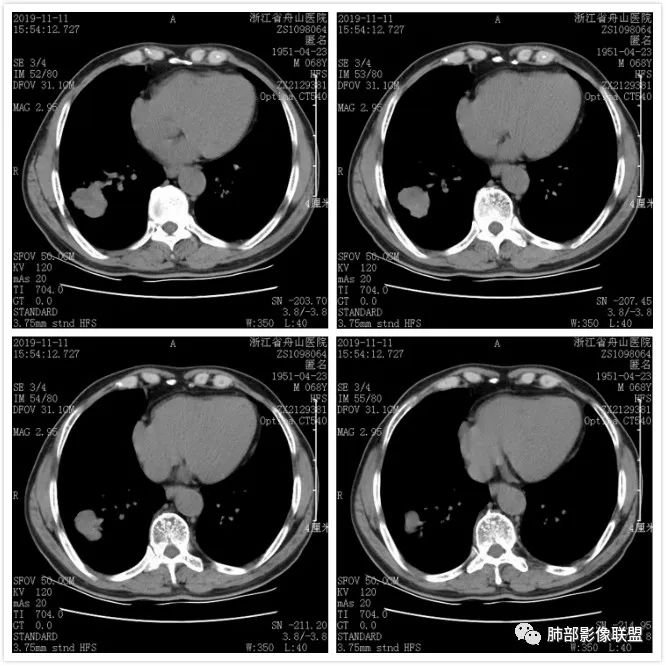 【病例】诡异的尿路肺转移瘤1例CT影像 【病例】诡异的尿路肺转移瘤1例CT影像
