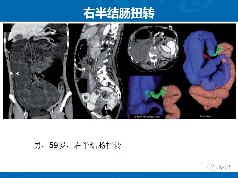 【PPT】结肠扭转CT诊断