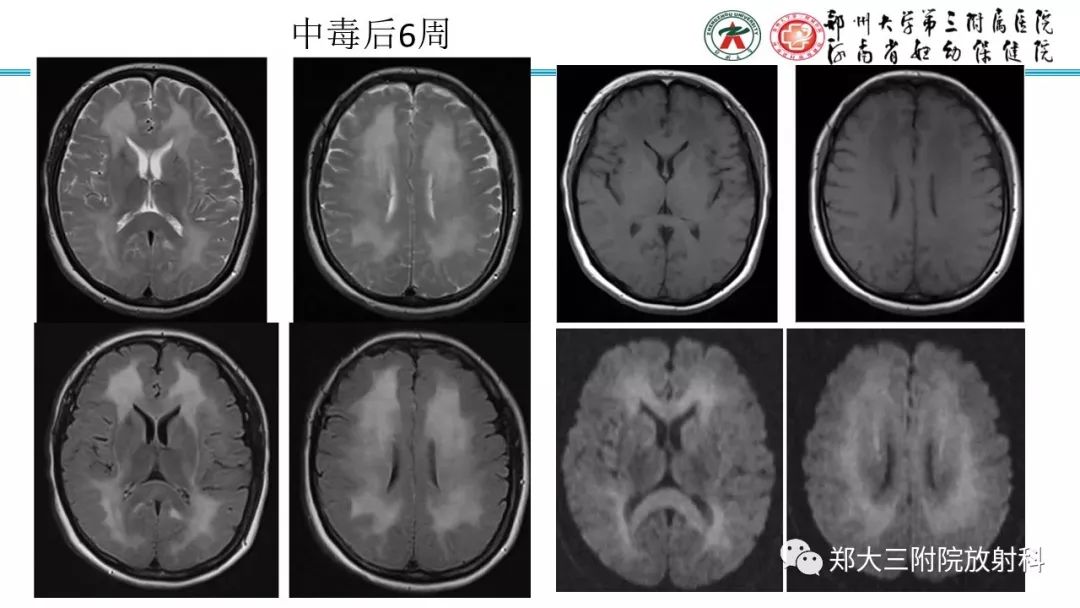 【PPT】中毒性脑病影像诊断