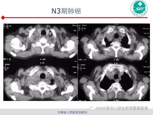 【PPT】胸部淋巴结分区及其在肺癌定性和分期诊断中的价值