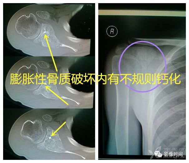 七大恶性骨肿瘤,背背诗就能了解啦! 七大恶性骨肿瘤,背背诗就能了解啦!