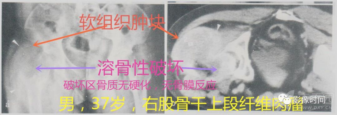 七大恶性骨肿瘤,背背诗就能了解啦! 七大恶性骨肿瘤,背背诗就能了解啦!