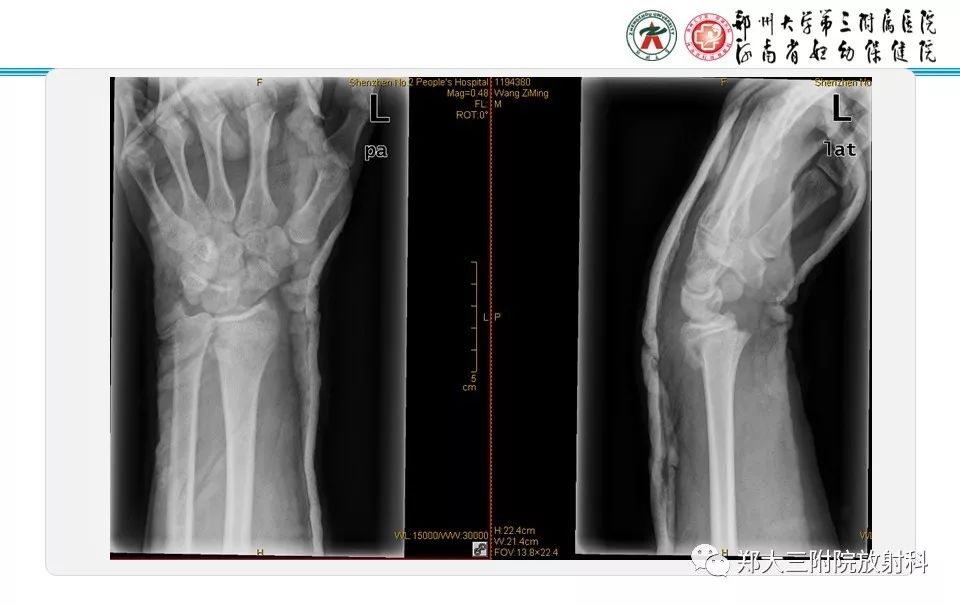 【PPT】骨骺损伤的影像诊断