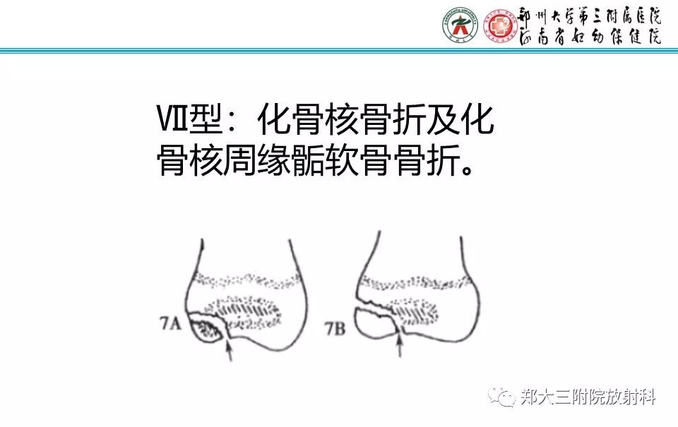 【PPT】骨骺损伤的影像诊断