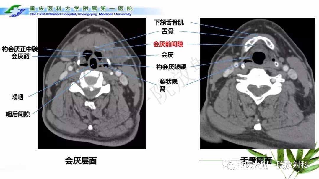 【PPT】咽部解剖及T分期影像诊断