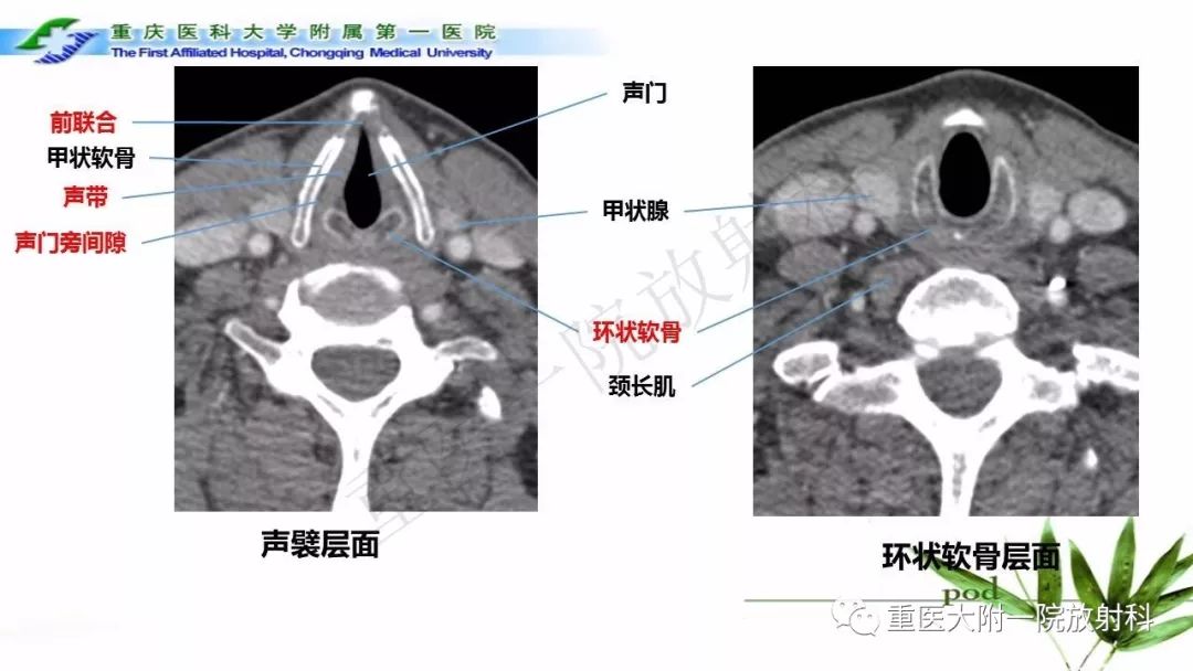 【PPT】咽部解剖及T分期影像诊断