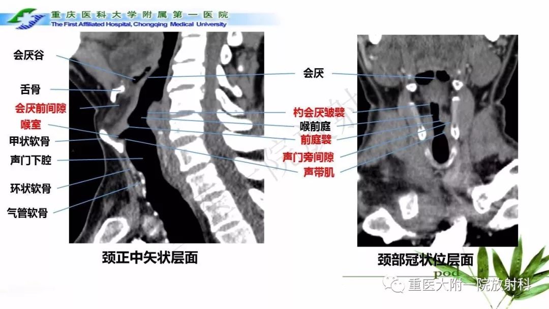 【PPT】咽部解剖及T分期影像诊断