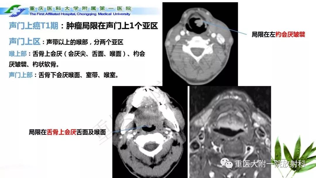 【PPT】咽部解剖及T分期影像诊断