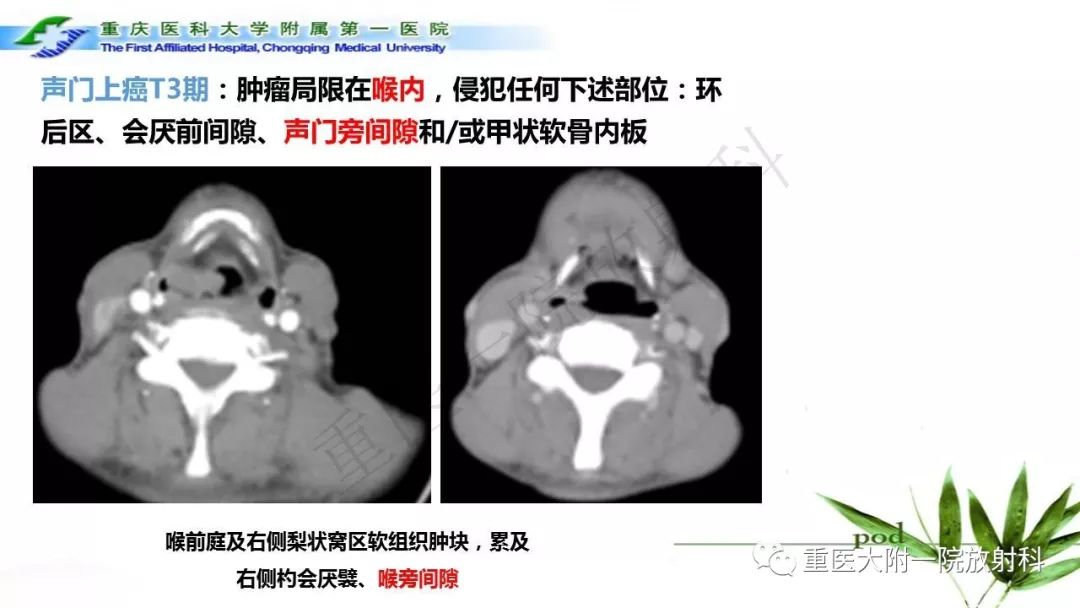【PPT】咽部解剖及T分期影像诊断