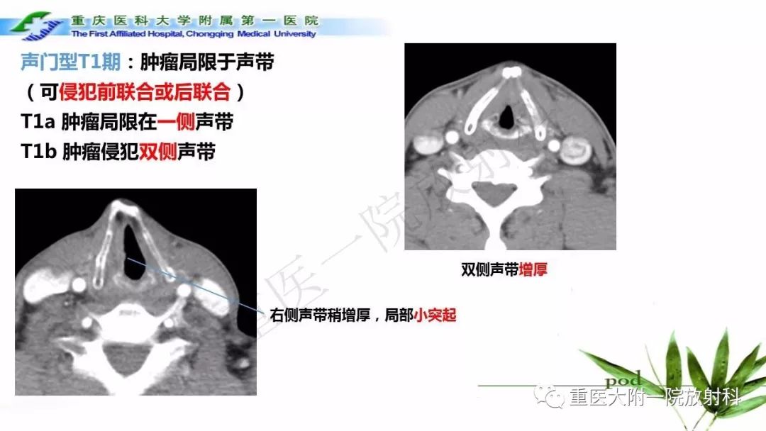 【PPT】咽部解剖及T分期影像诊断
