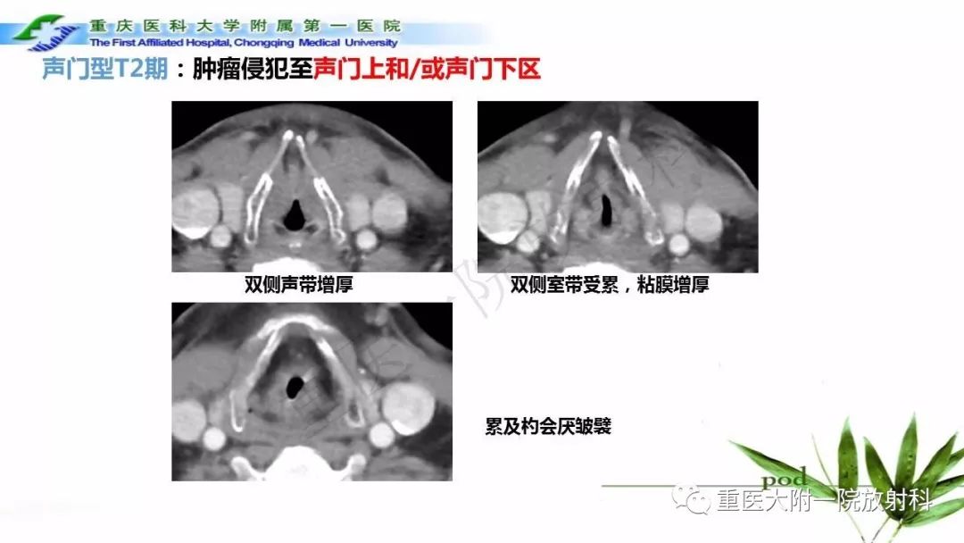 【PPT】咽部解剖及T分期影像诊断
