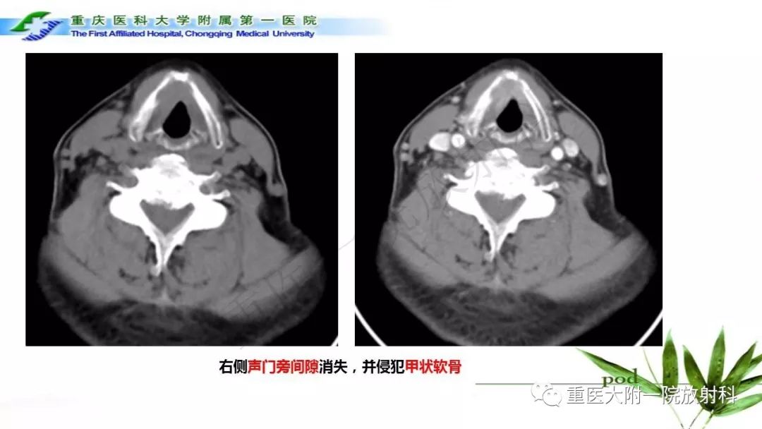 【PPT】咽部解剖及T分期影像诊断