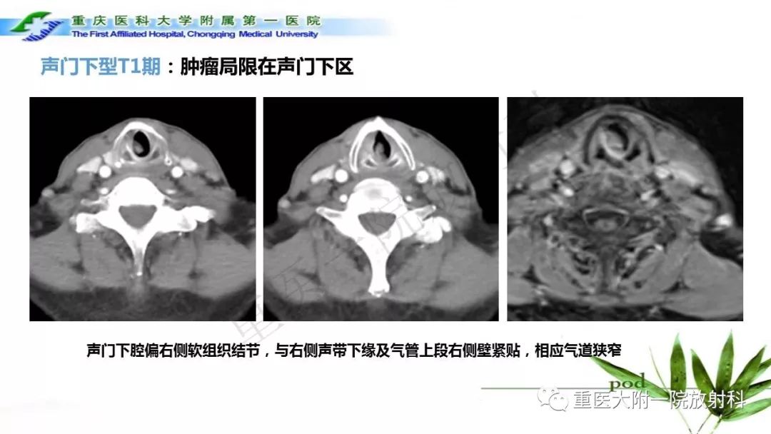 【PPT】咽部解剖及T分期影像诊断