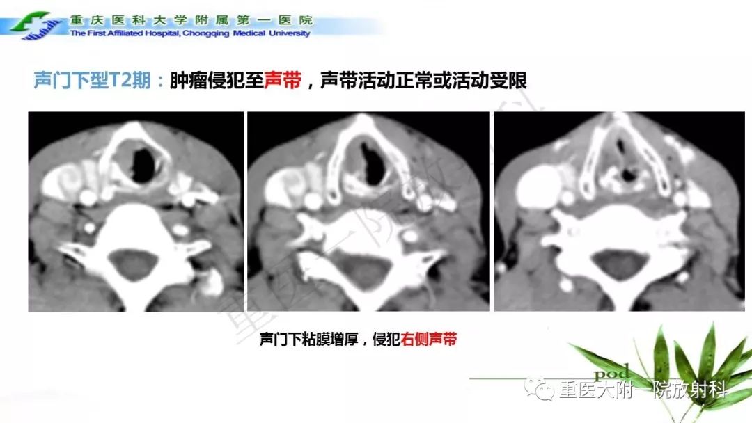 【PPT】咽部解剖及T分期影像诊断