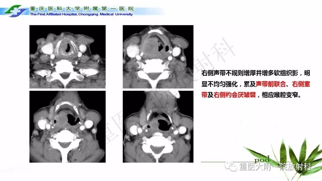 【PPT】咽部解剖及T分期影像诊断