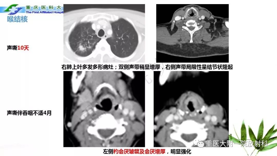 【PPT】咽部解剖及T分期影像诊断