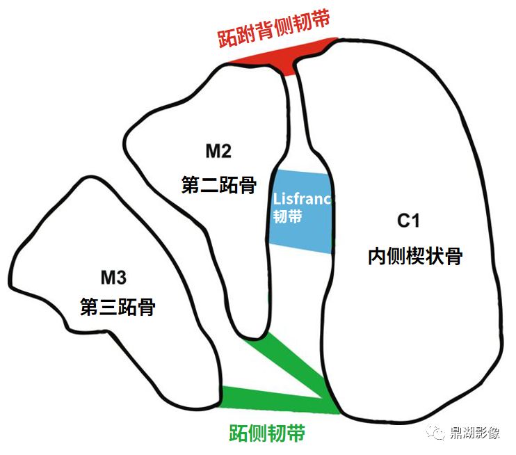 非常容易漏诊的Lisfranc损伤 非常容易漏诊的Lisfranc损伤