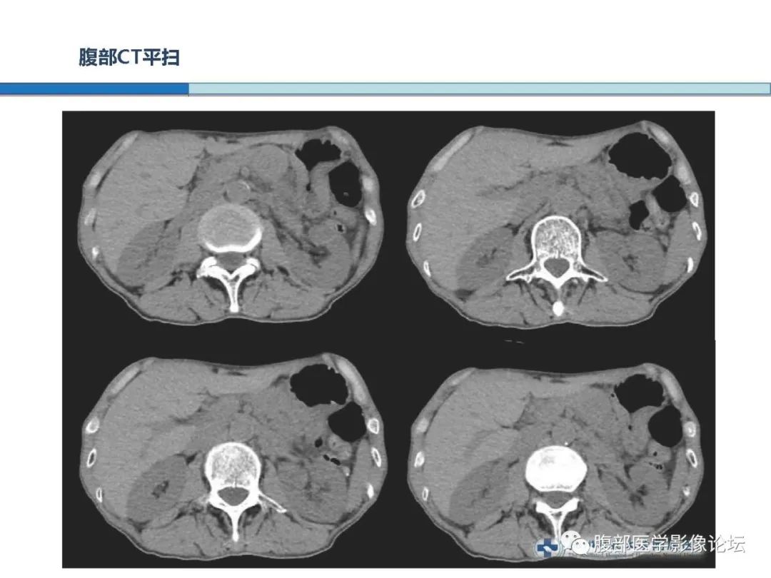 【病例】胰腺神经内分泌癌1例CT影像 【病例】胰腺神经内分泌癌1例CT影像