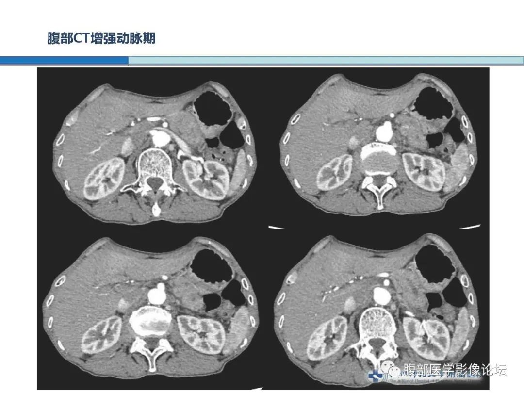 【病例】胰腺神经内分泌癌1例CT影像 【病例】胰腺神经内分泌癌1例CT影像