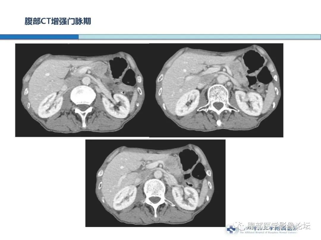 【病例】胰腺神经内分泌癌1例CT影像 【病例】胰腺神经内分泌癌1例CT影像