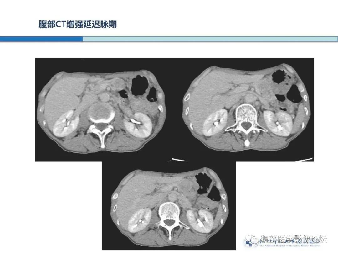 【病例】胰腺神经内分泌癌1例CT影像 【病例】胰腺神经内分泌癌1例CT影像