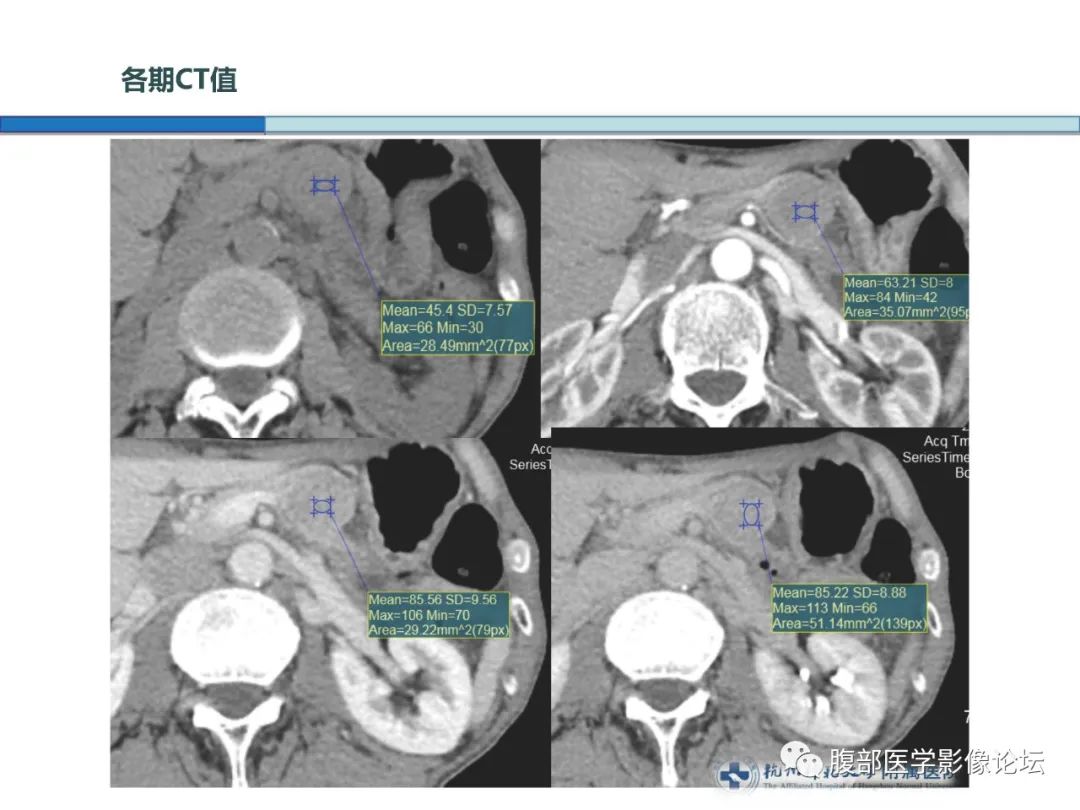 【病例】胰腺神经内分泌癌1例CT影像 【病例】胰腺神经内分泌癌1例CT影像