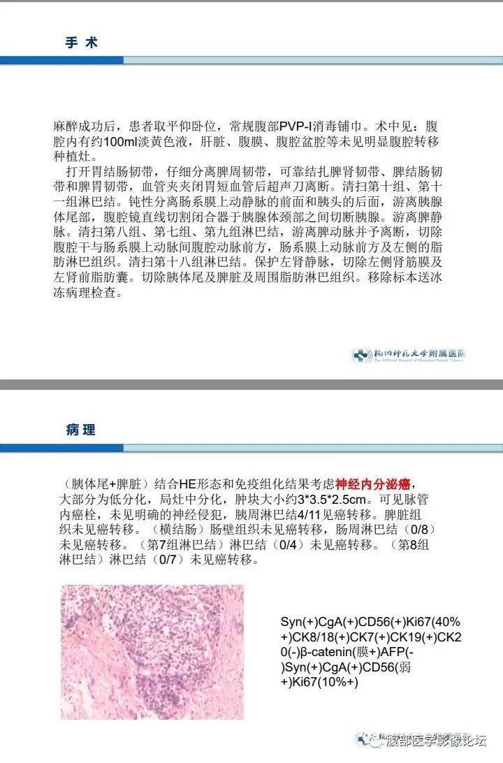 【病例】胰腺神经内分泌癌1例CT影像 【病例】胰腺神经内分泌癌1例CT影像