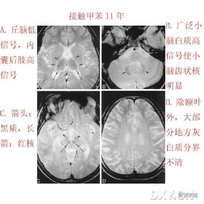 脑白质病变影像诊断
