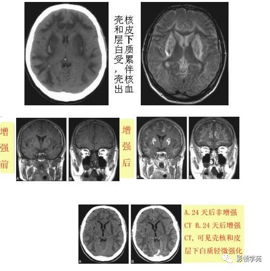 脑白质病变影像诊断
