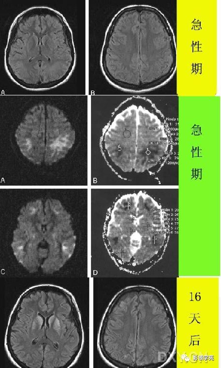 脑白质病变影像诊断