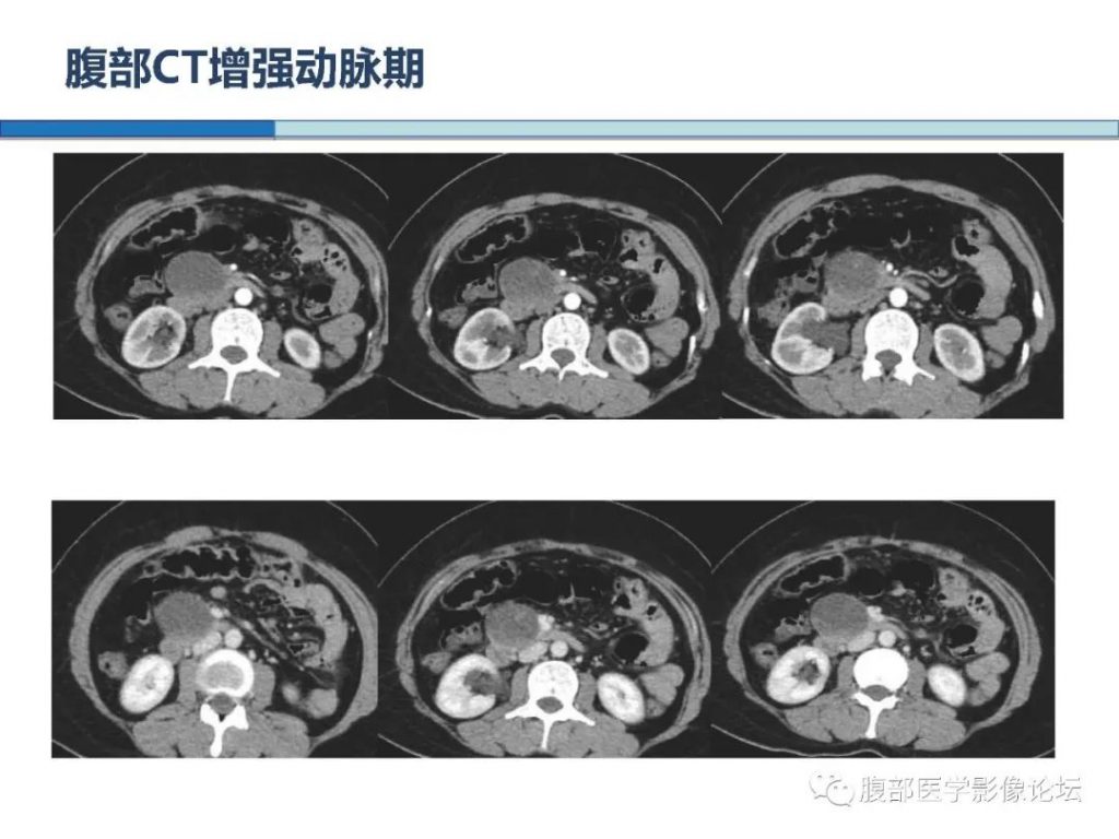 【病例】胰腺实性假乳头状肿瘤1例CT及MR