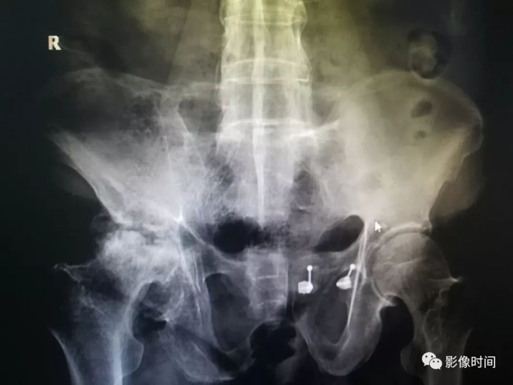 强直性脊柱炎的影像