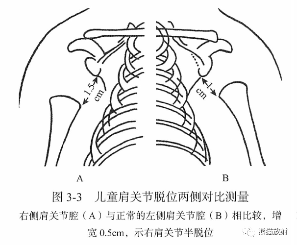 骨关节画线及测量 骨关节画线及测量