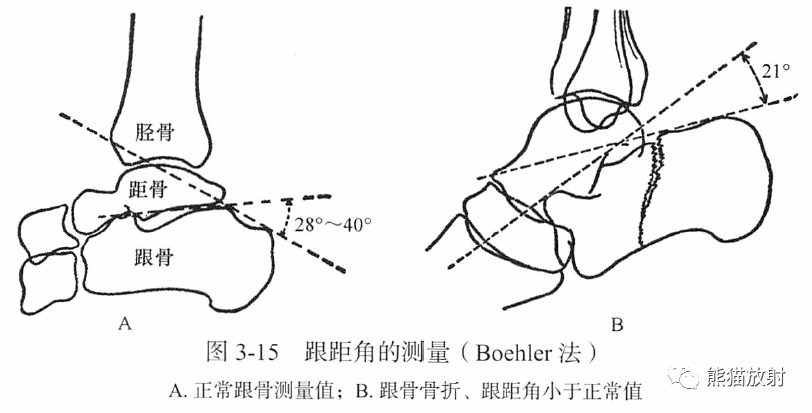 骨关节画线及测量 骨关节画线及测量