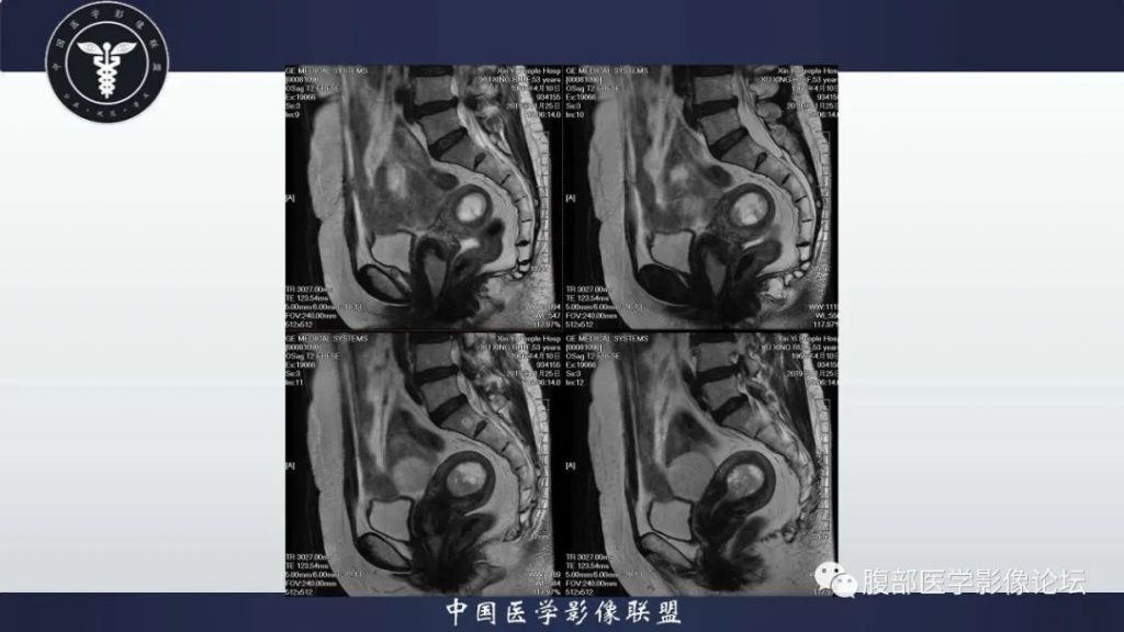 【病例】子宫内膜息肉1例MR影像