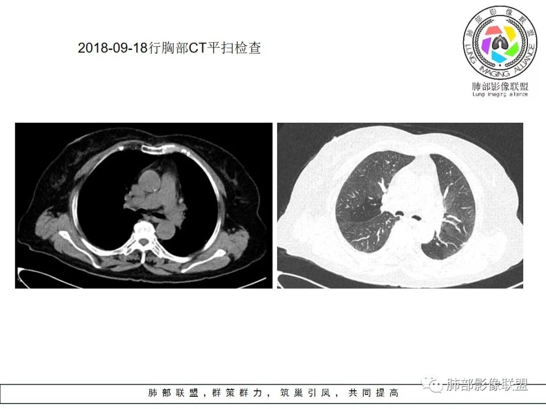 【病例】小征象大用途---脐凹征 【病例】小征象大用途---脐凹征