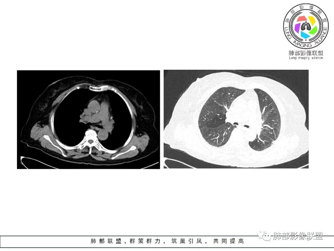 【病例】小征象大用途---脐凹征 【病例】小征象大用途---脐凹征