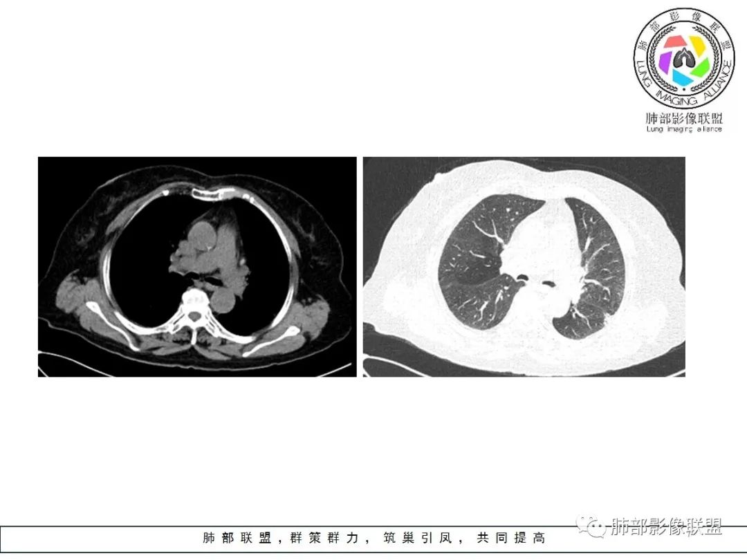 【病例】小征象大用途---脐凹征 【病例】小征象大用途---脐凹征