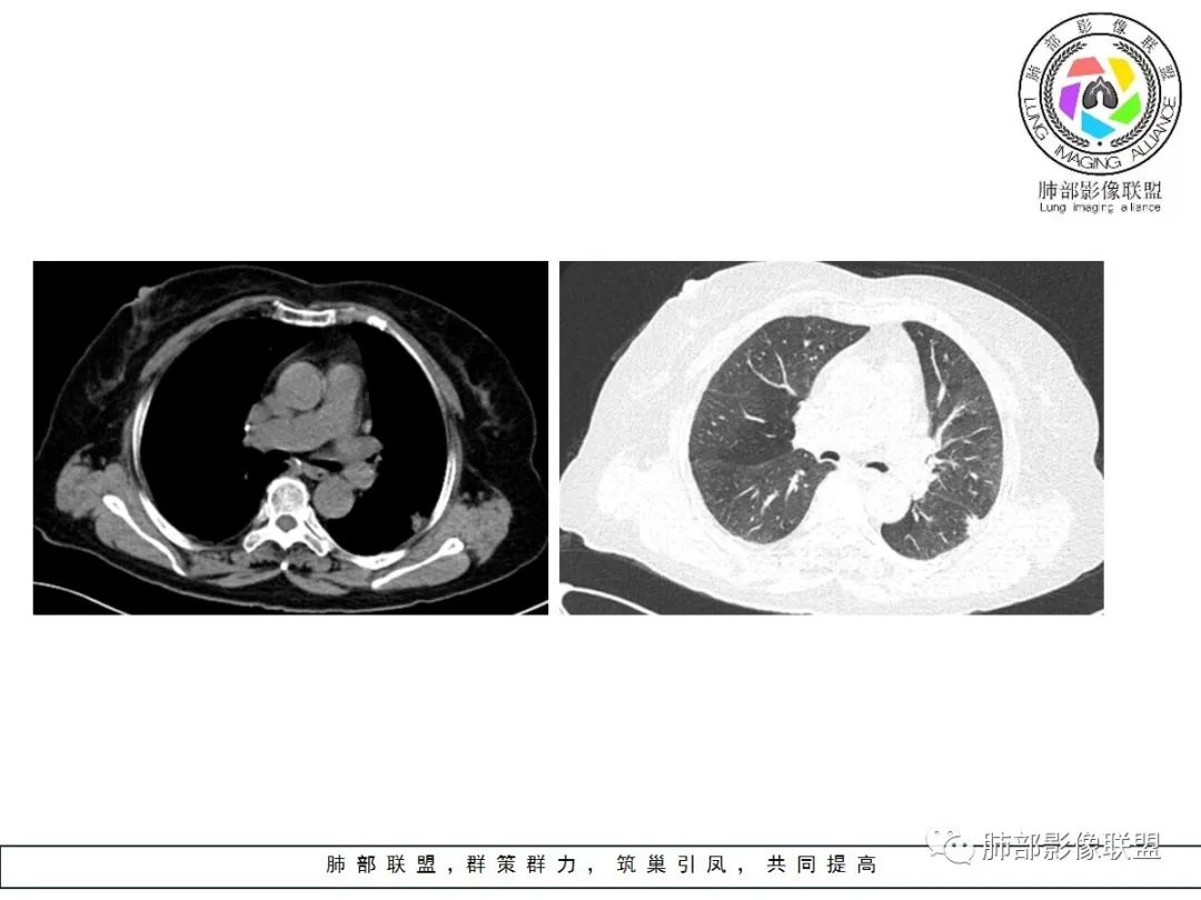 【病例】小征象大用途---脐凹征 【病例】小征象大用途---脐凹征