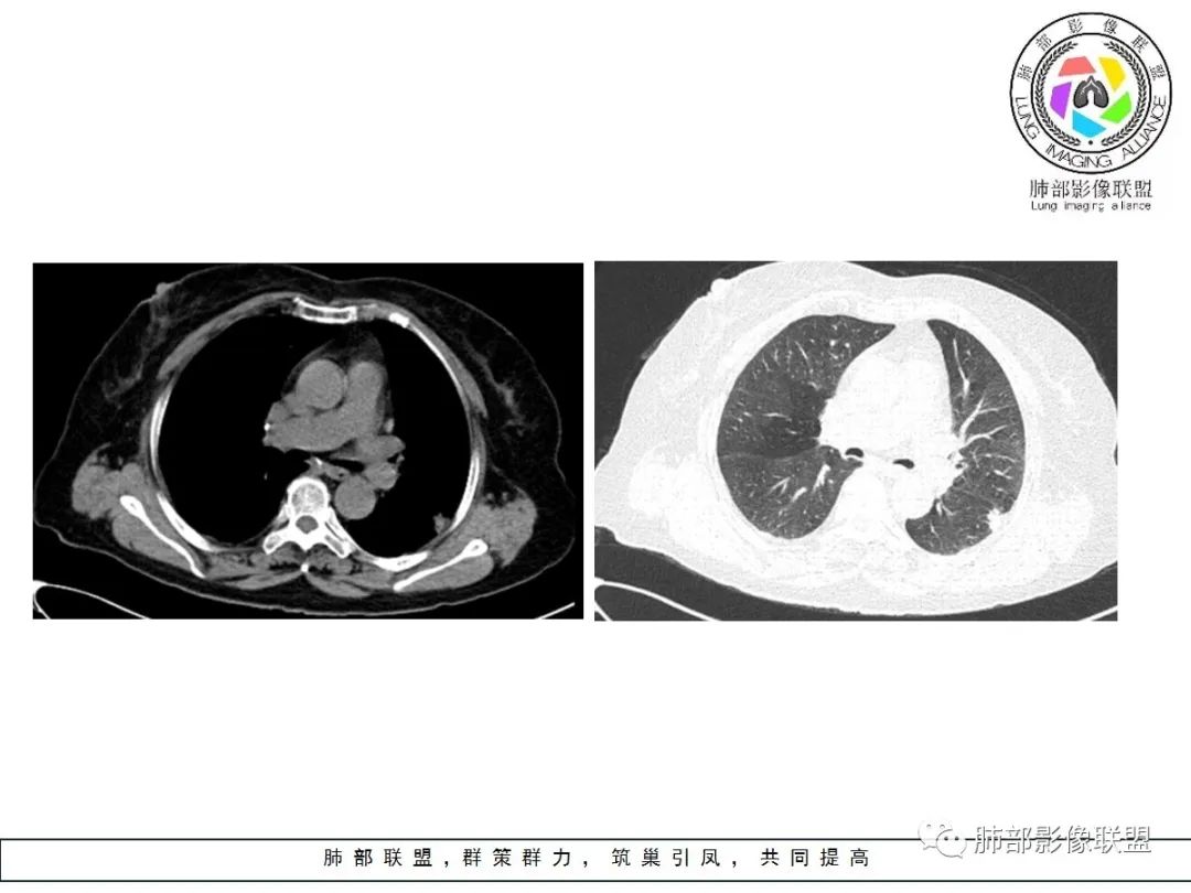 【病例】小征象大用途---脐凹征 【病例】小征象大用途---脐凹征