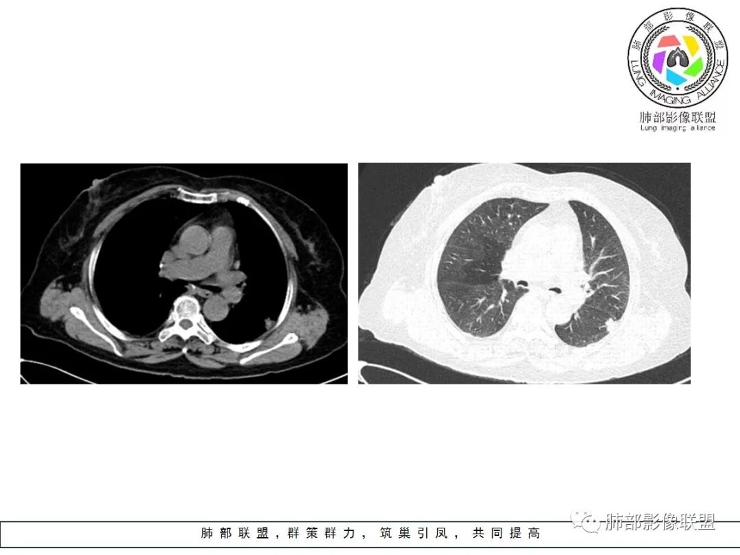 【病例】小征象大用途---脐凹征 【病例】小征象大用途---脐凹征