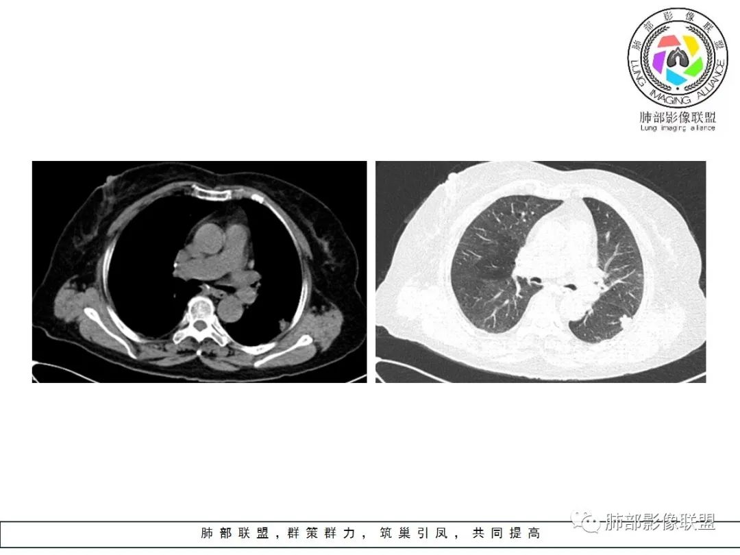 【病例】小征象大用途---脐凹征 【病例】小征象大用途---脐凹征