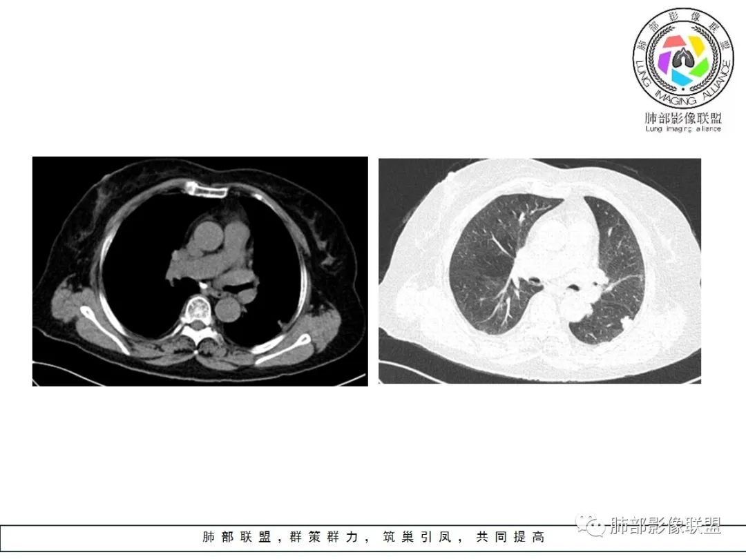 【病例】小征象大用途---脐凹征 【病例】小征象大用途---脐凹征