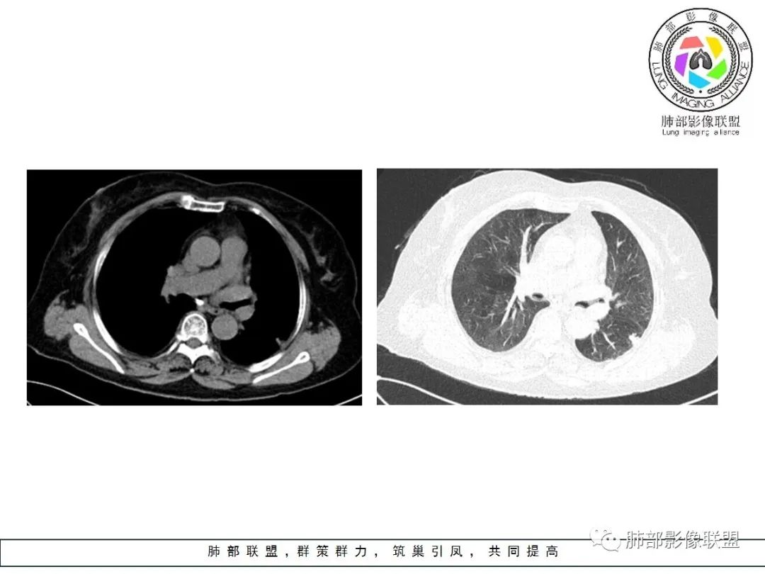 【病例】小征象大用途---脐凹征 【病例】小征象大用途---脐凹征
