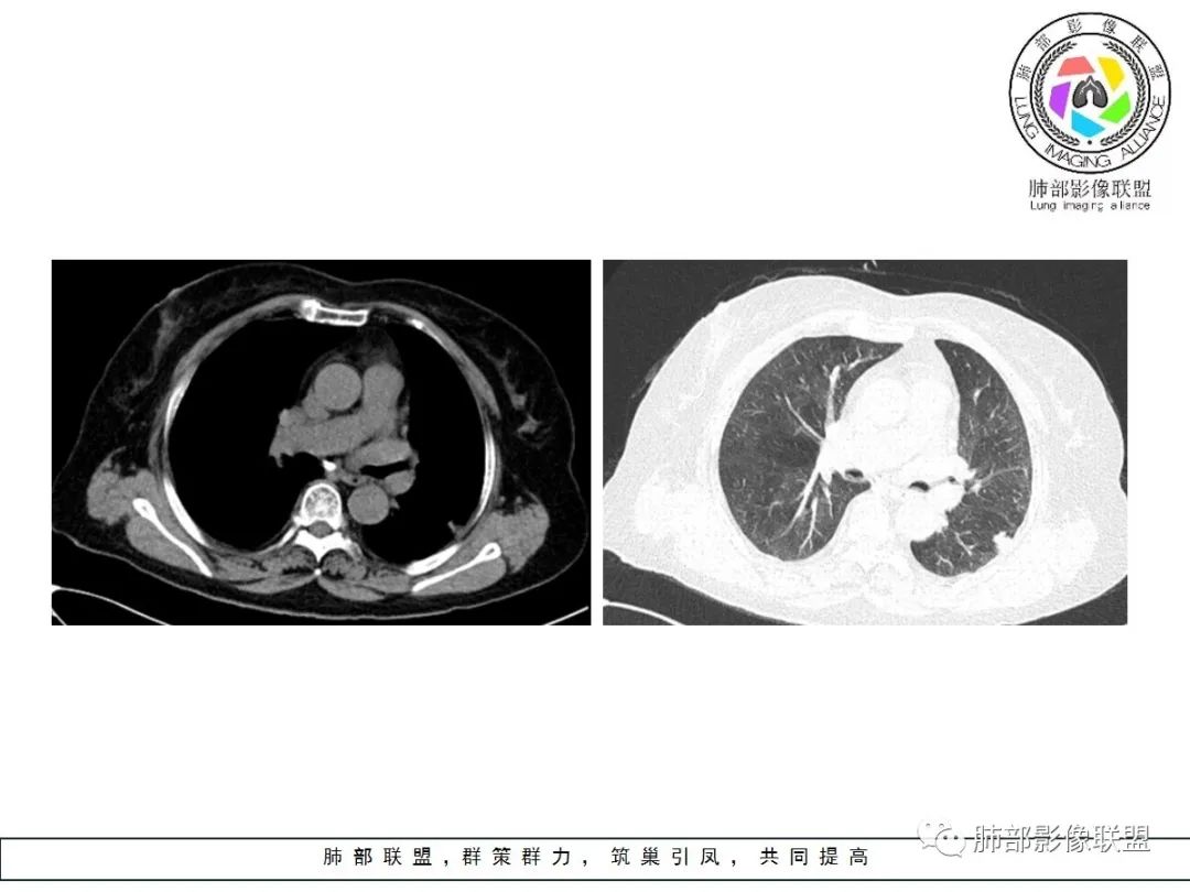 【病例】小征象大用途---脐凹征 【病例】小征象大用途---脐凹征