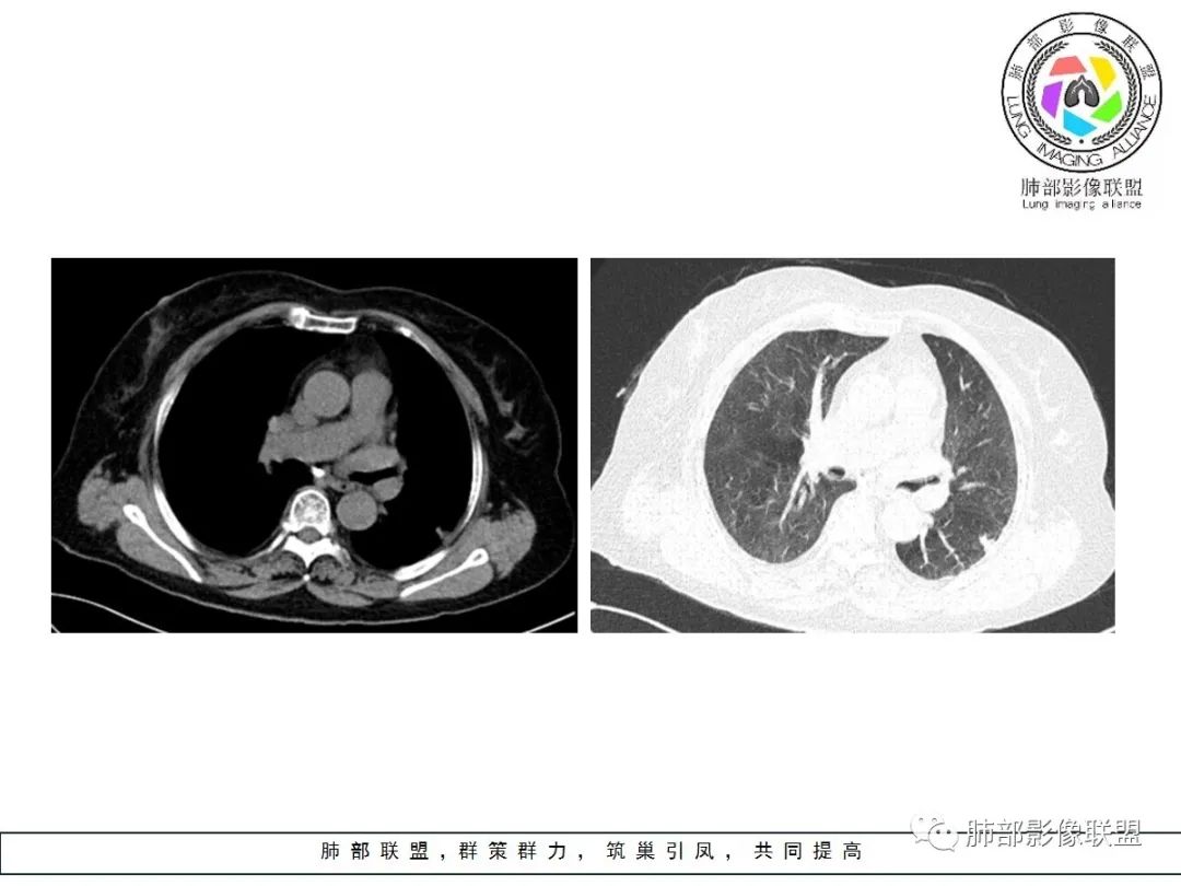 【病例】小征象大用途---脐凹征 【病例】小征象大用途---脐凹征