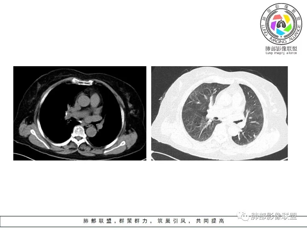 【病例】小征象大用途---脐凹征 【病例】小征象大用途---脐凹征