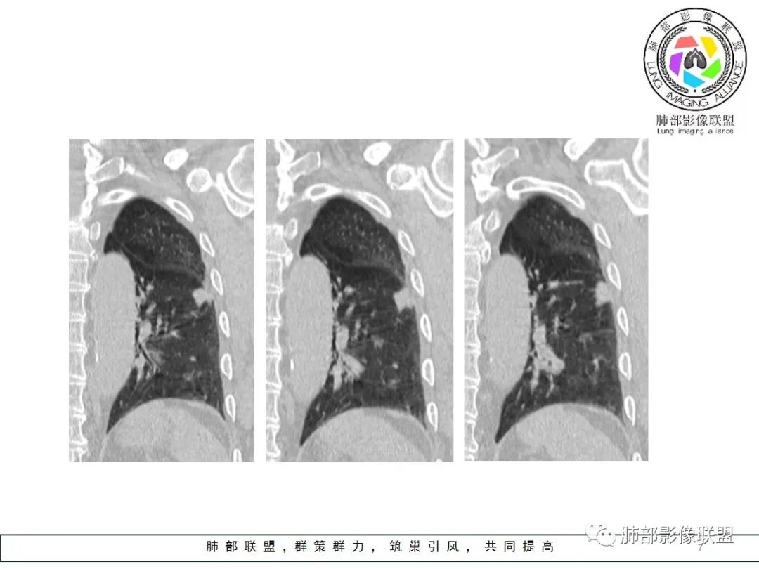 【病例】小征象大用途---脐凹征 【病例】小征象大用途---脐凹征