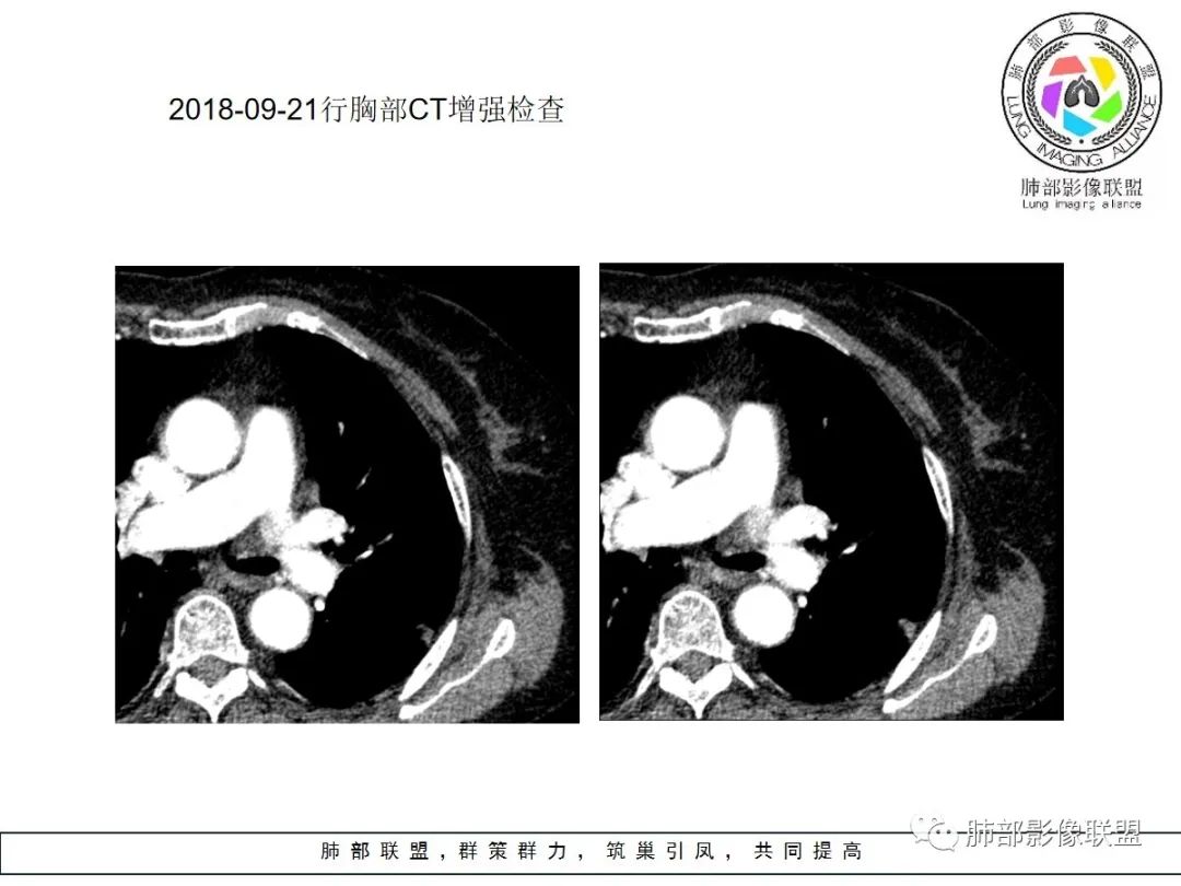 【病例】小征象大用途---脐凹征 【病例】小征象大用途---脐凹征