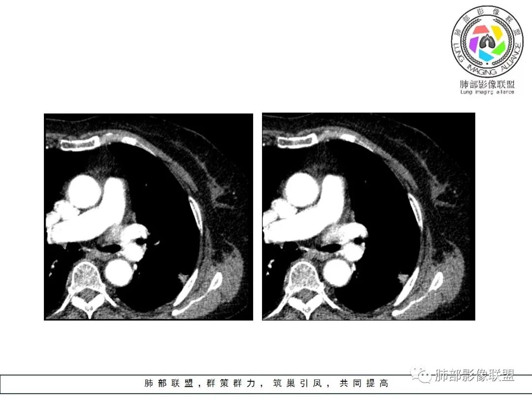 【病例】小征象大用途---脐凹征 【病例】小征象大用途---脐凹征